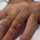 Шишки и наросты на пальцах рук — причины появления и лечение (с фото)