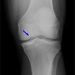 Остеохондроз коленного сустава: степени, симптомы и лечение