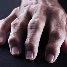 Ревматоидный артрит пальцев рук: первые симптомы, диагностика и лечение