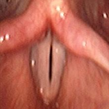 Несмыкание голосовых связок: причины, симптомы и лечение