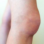 Отек коленного сустава причины: причины, симптомы и лечение