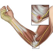 Воспаление нерва в локтевом суставе — симптомы, диагностика и лечение