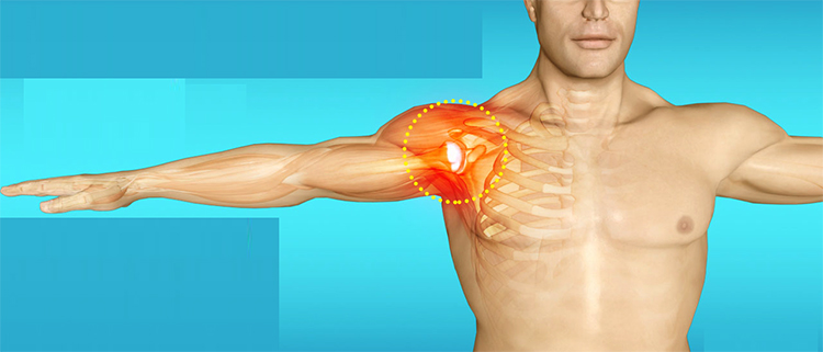 Воспаление в плечевом суставе
