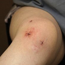 Реабилитация и восстановление после артроскопии коленного сустава
