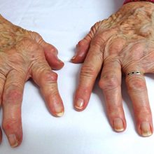Кривые пальцы на руках: причины и что делать