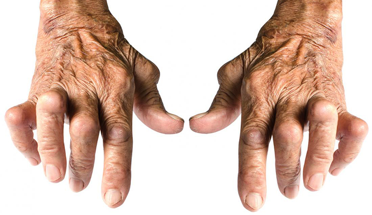 Артрит пальцев рук
