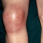 Подагрический артрит коленного сустава: симптомы, диагностика и лечение