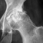 Остеопороз тазобедренного сустава: симптомы, диагностика и лечение