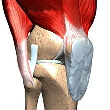 Препателлярный бурсит коленного сустава — что это, симптомы и лечение