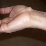 Могильная кость на руке: что это такое, причины и что делать
