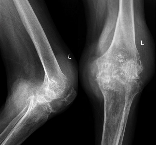 Подагрический артрит коленного сустава на снимке