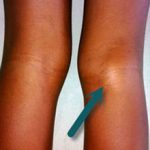 Киста коленного сустава: виды, симптомы и лечение