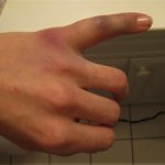 Перелом мизинца на руке: симптомы, диагностика и как лечить