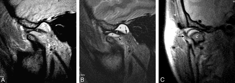 Снимки МРТ височно-нижнечелюстного сустава