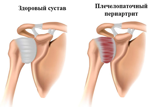 Изображение - Лфк при периартрите плечевого сустава комплекс упражнений nor_pat-1