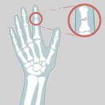 Перелом пальца руки: симптомы, диагностика и лечение