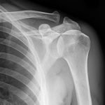 Рентген плечевого сустава — что показывает и как проводится