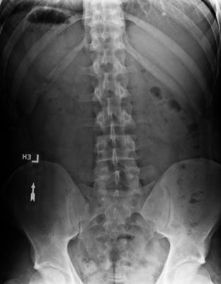 Рентгеновский снимок спины