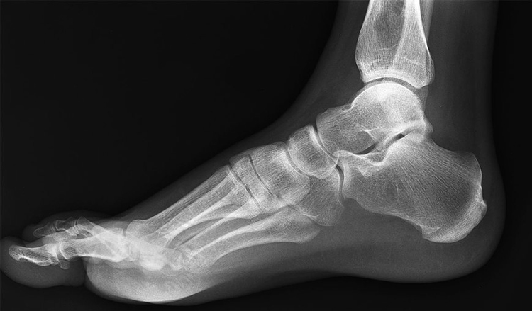 Рентген ноги
