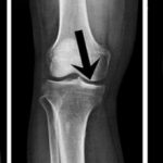 Остеосклероз коленного сустава — причины, симптомы и методы лечения