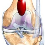 Супрапателлярный бурсит коленного сустава: симптомы и лечение