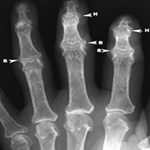 Артроз суставов пальцев рук: симптомы, диагностика и лечение