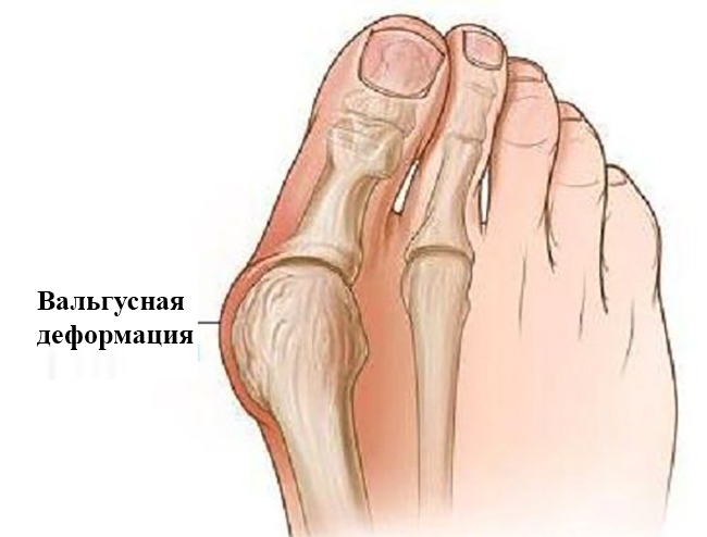 Деформации суставов пальцев ног