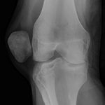 Смещение коленной чашечки — причины, симптомы, диагностика и лечение