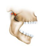 Подвывих челюстного сустава: симптомы, диагностика и лечение
