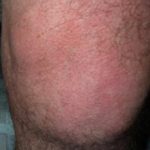 Выпот в коленном суставе: причины появления, симптомы и лечение