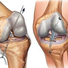 Пластика передней крестообразной связки коленного сустава — что это и как проводится