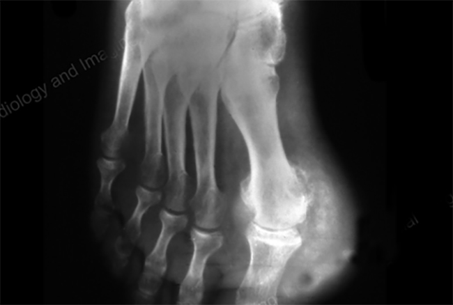 Рентгеновский снимок бурсита