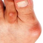 Бурсит большого пальца стопы: причины, симптомы и методы лечения