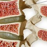 Диффузный остеопороз: что это, симптомы и лечение