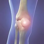 Гигрома коленного сустава: стадии, симптомы и лечение