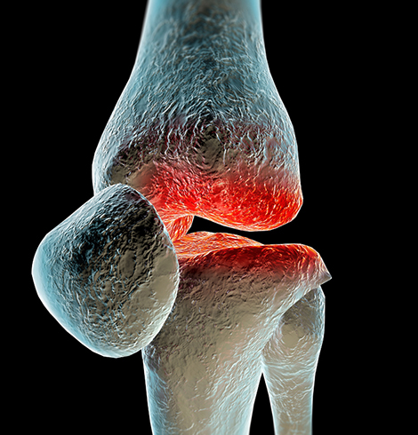 Первичный генерализованный остеоартроз колена