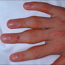 Опухают суставы на пальцах рук: причины и что делать