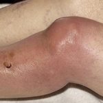 Гнойный бурсит коленного сустава: причины, симптоматика и как лечить