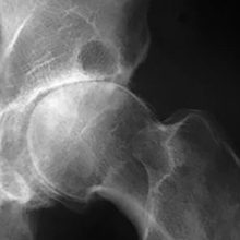 Первичный генерализованный остеоартроз: симптомы, диагностика и лечение
