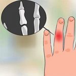 Если выбил палец на руке: что делать и как лечить