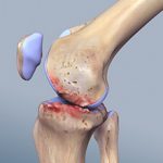 Полиартрит коленного сустава: причины, симптоматика и как лечить