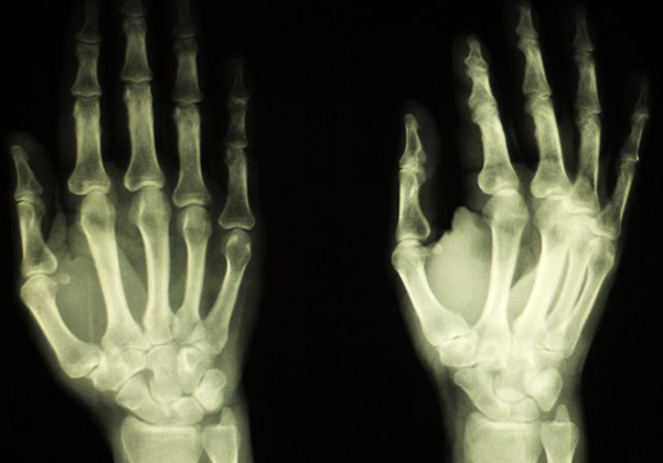 Рентген рук