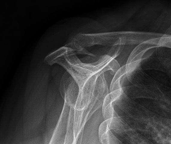 Изображение - Обызвествление связок плечевого сустава лечение reent_pl