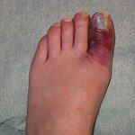 Перелом большого пальца на ноге: признаки и лечение
