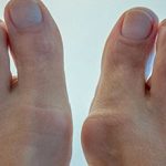 Шишки на пальцах ног — причины появления и как лечить