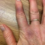 Сильный ушиб пальца: симптомы и что делать