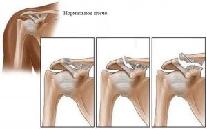 Ключичное сочленение фото