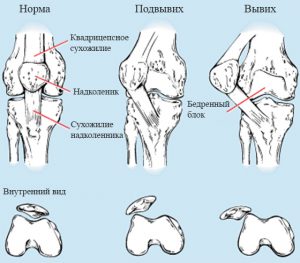 Вывих надколенника карта вызова