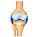 Остеоартроз коленного сустава 1 степени: симптомы, диагностика и лечение