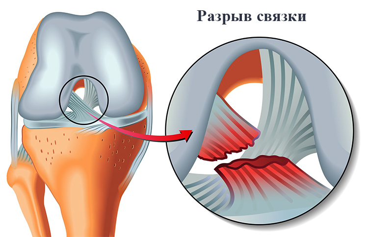 Изображение - Коллатеральные связки коленного сустава анатомия razr12-1